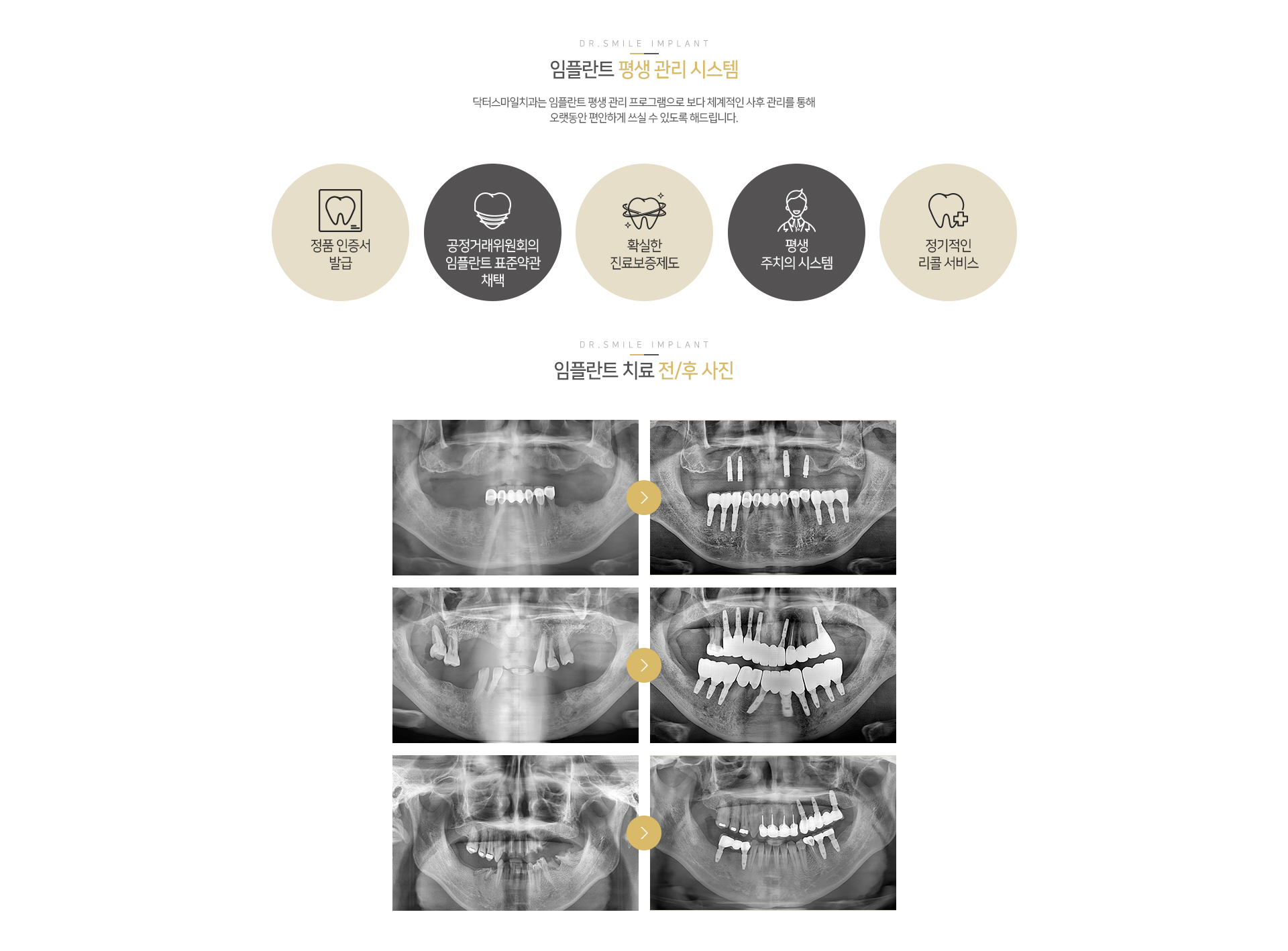 닥터스마일 임플란트