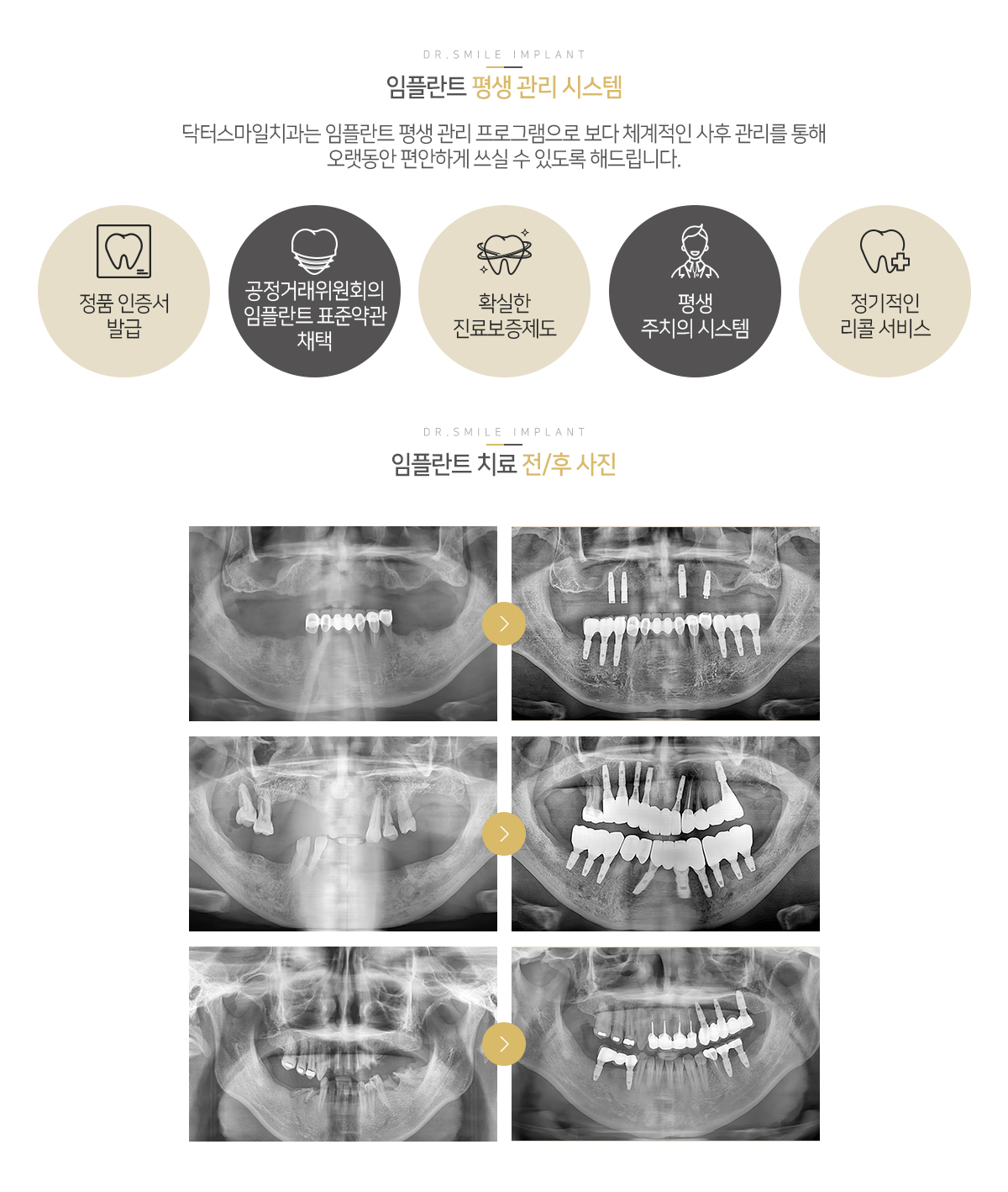 닥터스마일 임플란트